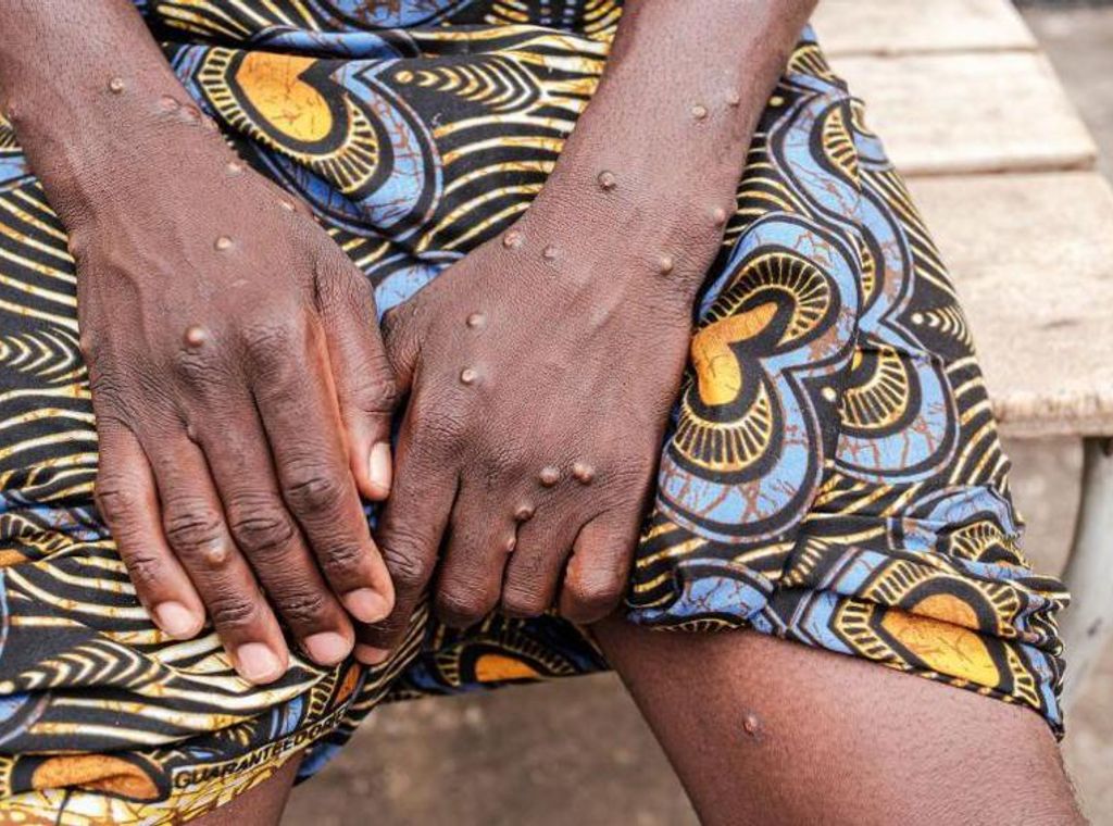 Ghana confirms 2 new cases of Mpox