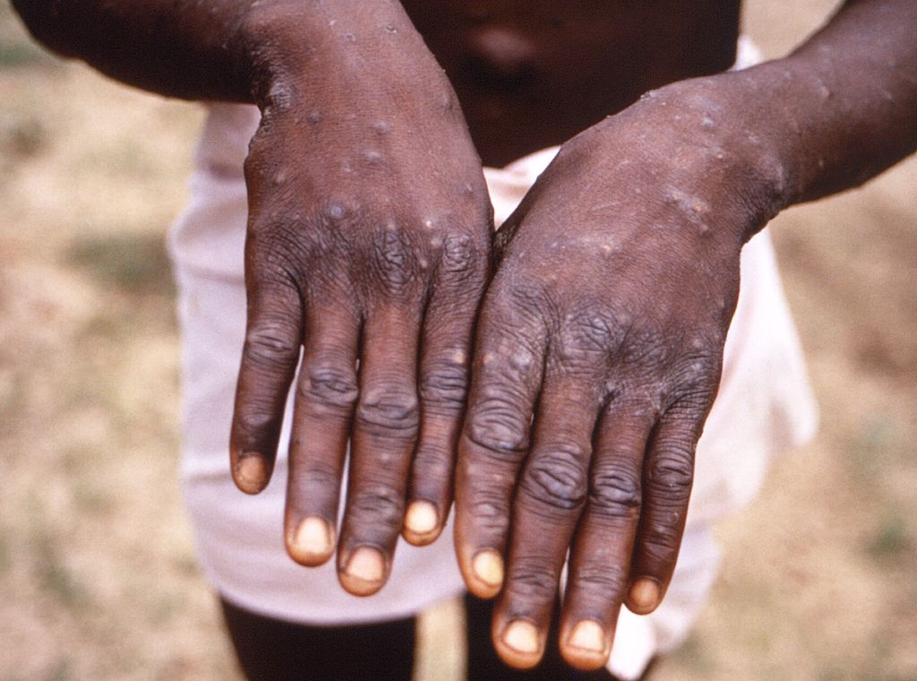 Ghana records 14 new Mpox cases, no deaths or hospitalizations