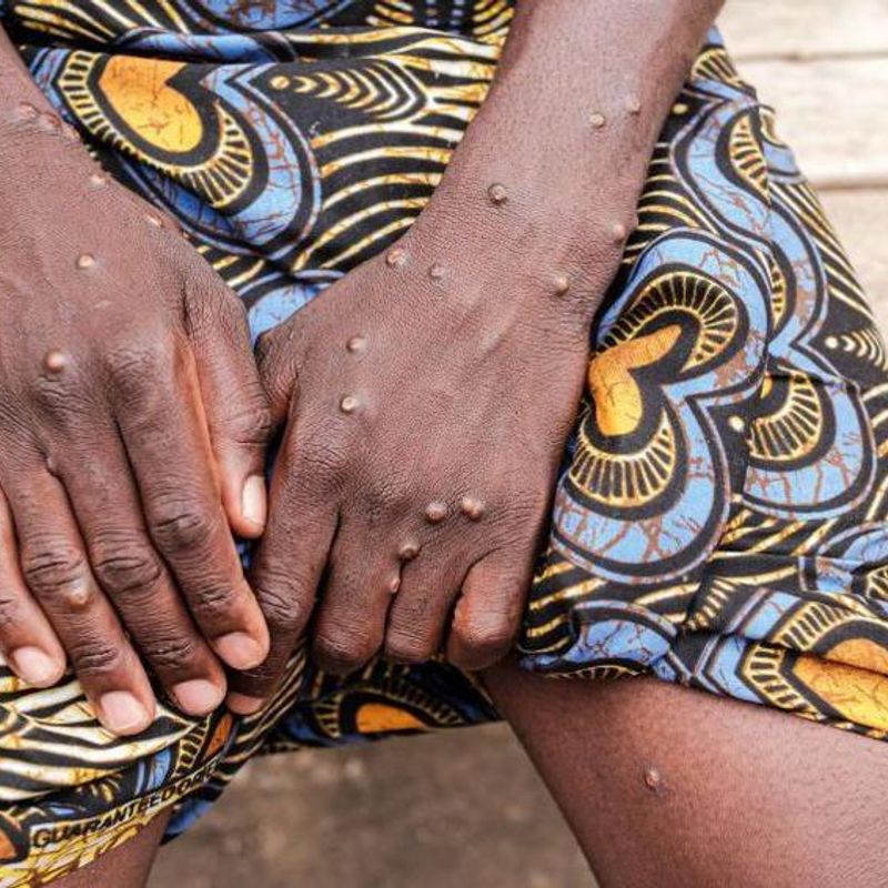 Ghana confirms 2 new cases of Mpox