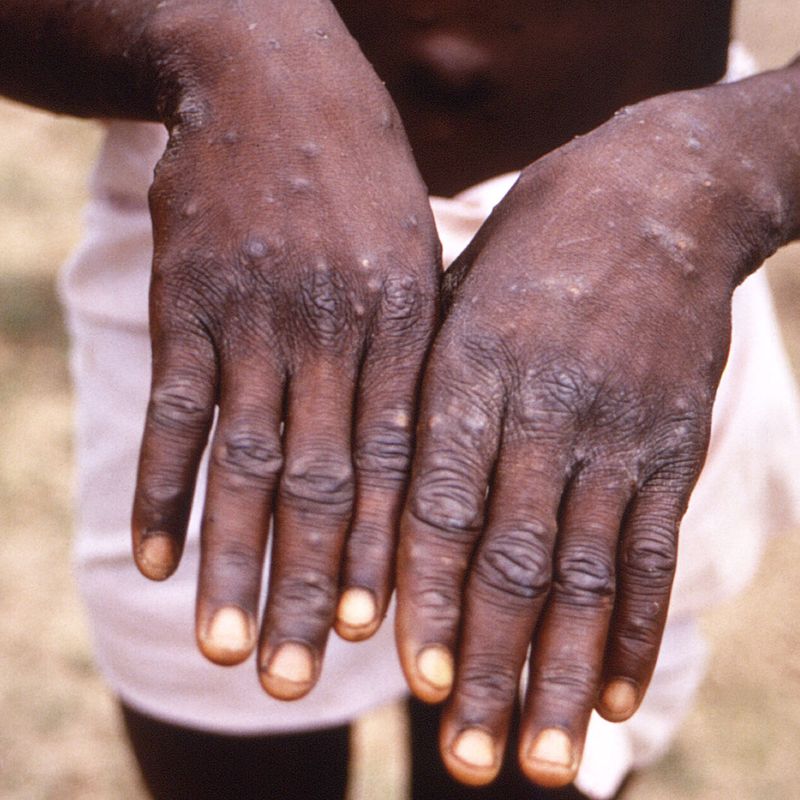Ghana records 14 new Mpox cases, no deaths or hospitalizations